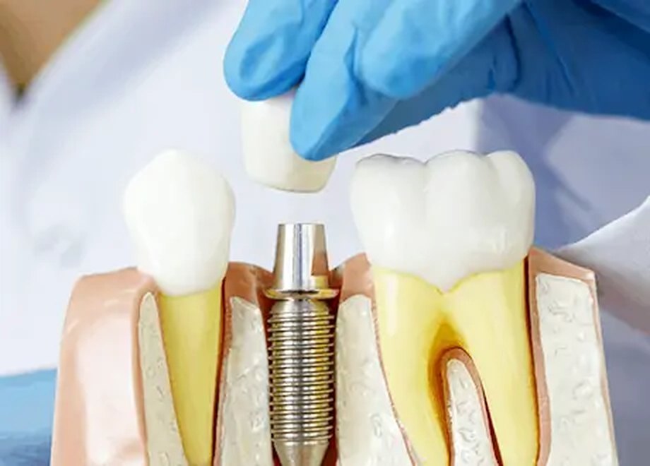 Dental implants
